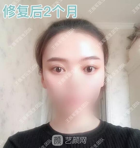 双眼皮修复术后两个月果