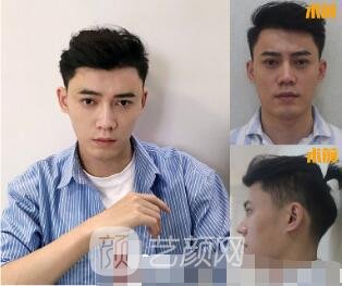 自体脂肪面部填充全脸案例图