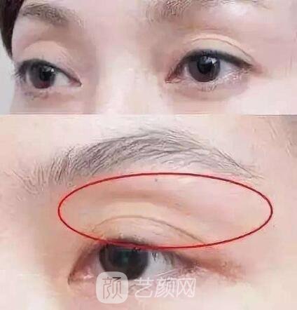 科普：自体脂肪填充眼窝后遗症有这些，你造吗？