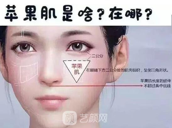 苹果肌是什么