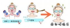 面部吸脂手术的价格详情 大饼脸变瓜子脸