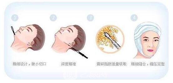 所谓面部吸脂手术，需要医生在手术前根据患者自身面部比例的情况