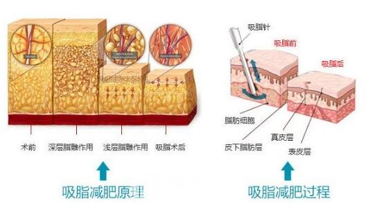 抽脂后应定期口服一些抗生素以防止感染
