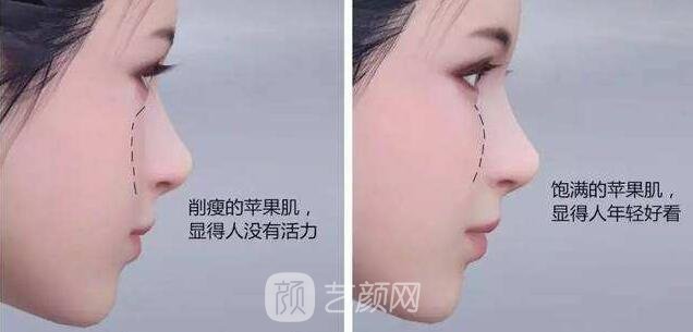 自体脂肪填充苹果肌