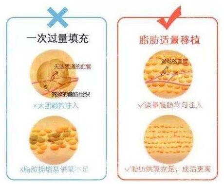 脂肪填充术后要注意忌口，忌辛辣刺激性食物