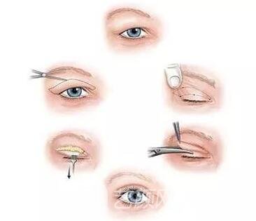 全切双眼皮手术步骤图