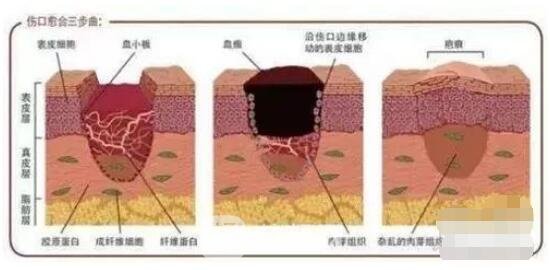 疤痕产生流程