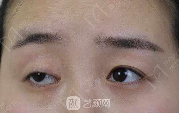 上睑下垂如果不重视双眼皮做了也白做！