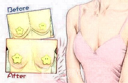 复合型丰胸手术的优势有什么?