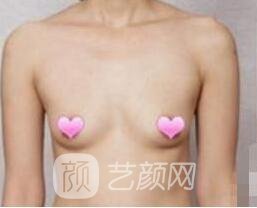 丰胸手术后可以孕期哺乳吗?