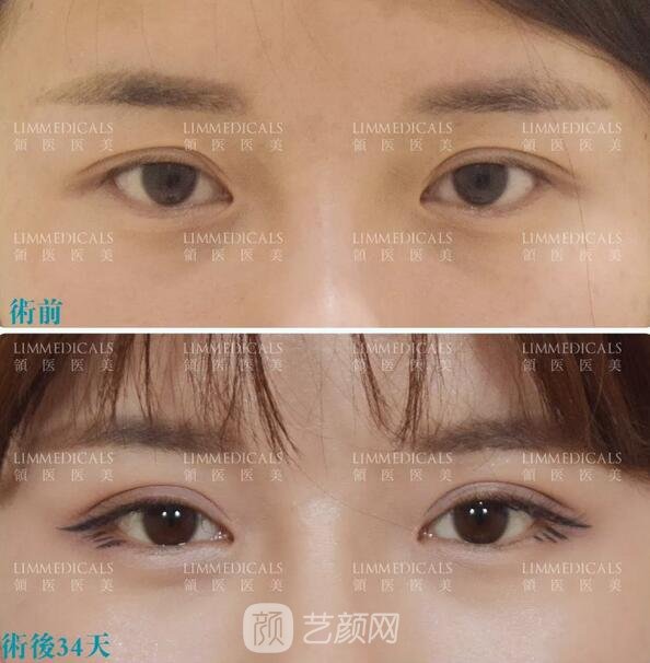 双眼皮案例图