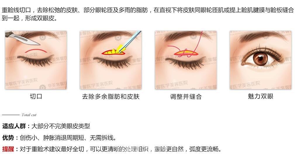 割双眼皮哪种方法好？全切怎么样