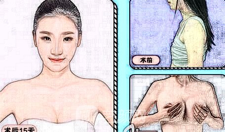 隆胸优惠活动价钱大约多少钱?