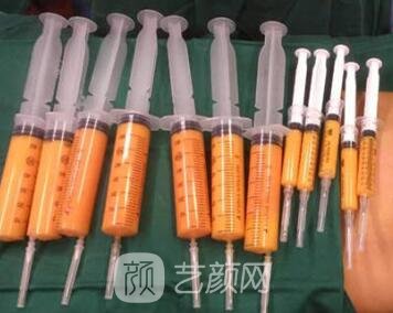 假体丰胸挑选哪些原材料好?