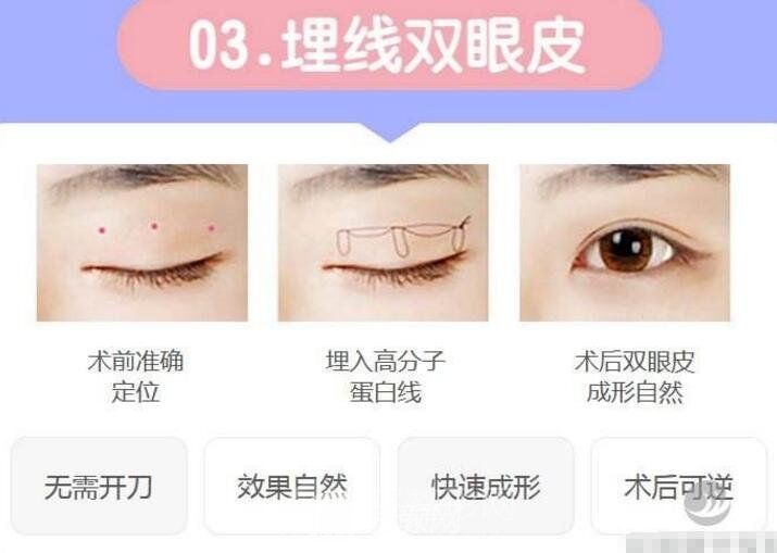 拉线双眼皮是埋线吗？