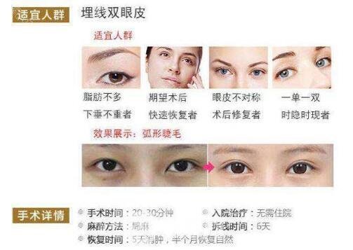 拉线双眼皮是埋线吗？适合哪些人？