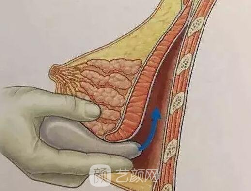 妙桃假体的三大特点