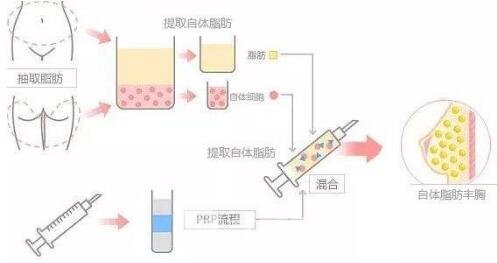 自体脂肪隆胸术有哪些禁忌？