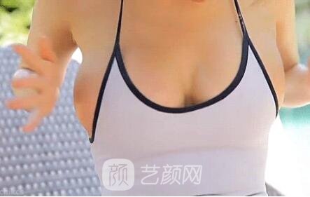 如何选择假体形状?