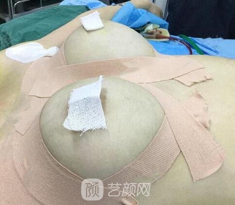 假体隆胸术后一定要做好护理工作哦!