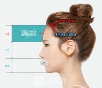 一组案例图了解韩国ID整形医院发际线额头缩小术优势与价格