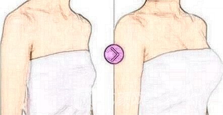 假体丰胸外观设计和手感是否会很假?