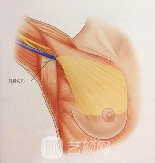 不一样的丰胸手术痛疼水平大不一样