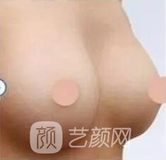 胸部敏感度会受隆胸手术的影响吗?