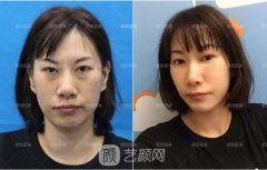 为什么要做去眼袋？这三个理由就够了！