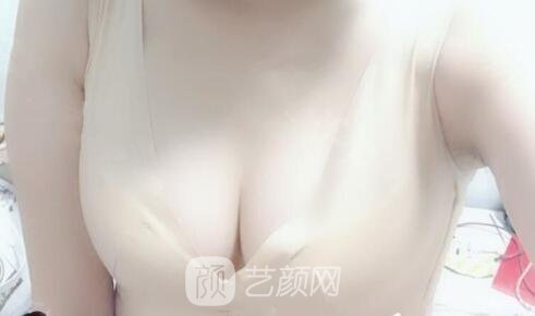 真实影响造成胸部下垂的要素是什么？