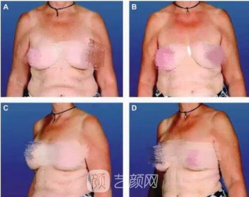 哺乳是否会导致胸部下垂？