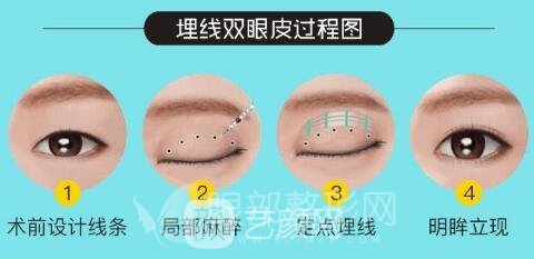 眼部微整形：重睑术+祛除鱼尾纹+祛眼袋，要不要来一套！