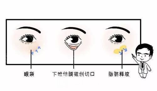 眼部微整形 去眼袋果好不好
