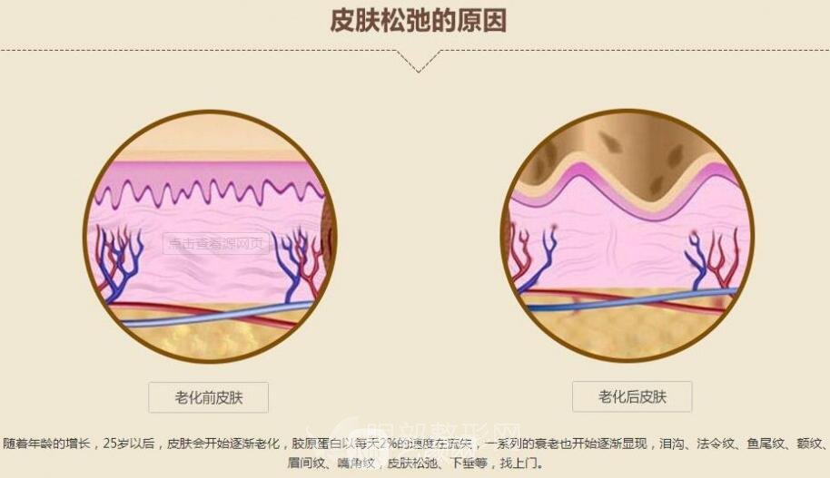 眼部微整形 祛除鱼尾纹 果好不好