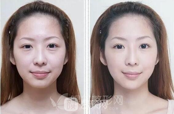 去眼袋手术果 术前术后