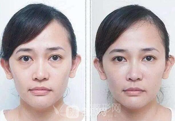 去眼袋手术果图