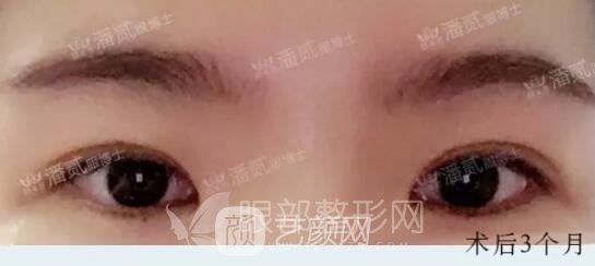 韩式小切口双眼皮案例图，术后3个月果图