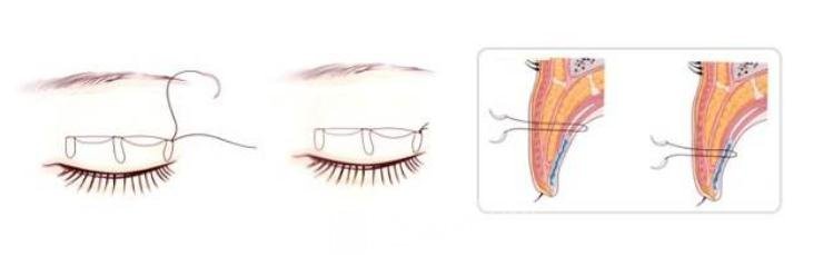 埋线双眼皮手术原理图