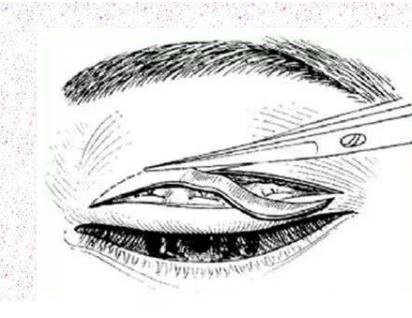 全切双眼皮手术原理图