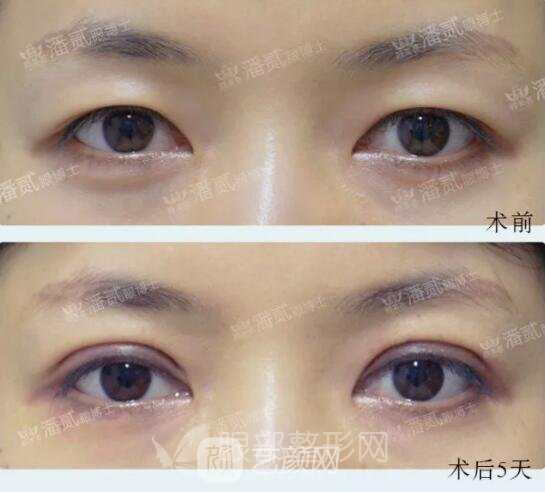 全切双眼皮果图，术后5天