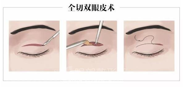 割双眼皮较全攻略，术前你一定要get的知识！