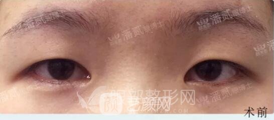 韩式小切口双眼皮案例图，术前
