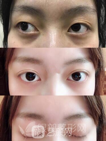 埋线双眼皮真人案例图
