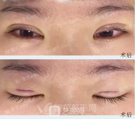 韩式小切口双眼皮案例图，术后果