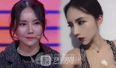 双眼皮过宽 疤痕