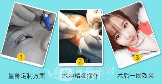 双眼皮手术过程