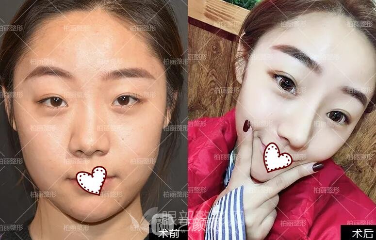 开眼角多久恢复?医生告诉我至少需要30天!