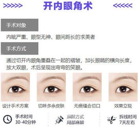 开眼角手术