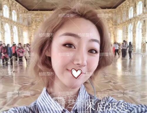 开眼角术后恢复过程图 真人案例