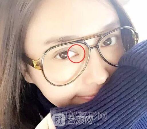 明星也要开眼角